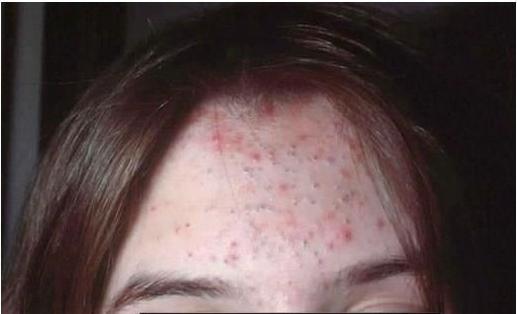 9o02s-acné.jpg
