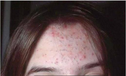 282s7-acne.jpg